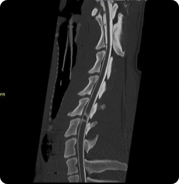 Immagine TAC veterinaria della colonna vertebrale per l'individuazione di cisti di Tarlov, sacche benigne ripiene di liquido cerebrospinale che si formano sulle radici dei nervi spinali